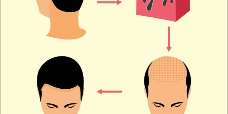 Male hair transplant & hair loss treatment medical infographic – free vector